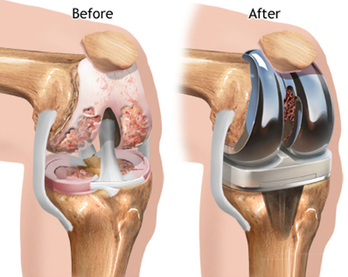 Деформирующий остеоартроз коленного сустава эндопротез